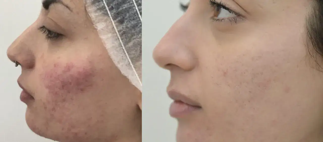 Prima e dopo un peeling per acne: la pelle è visibilmente più liscia e uniforme, con meno rossori e imperfezioni.