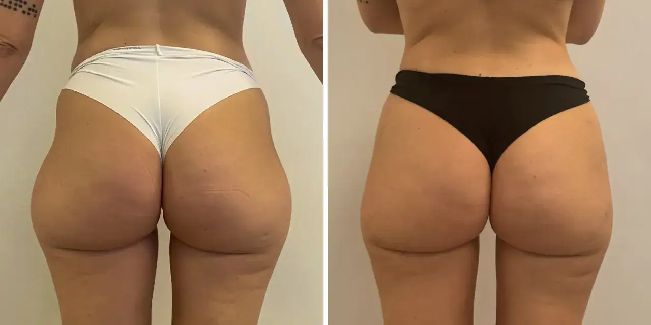 Risultato di gluteoplastica senza protesi: un aumento di volume e forma naturale dei glutei, con un aspetto più armonioso e tonico.
