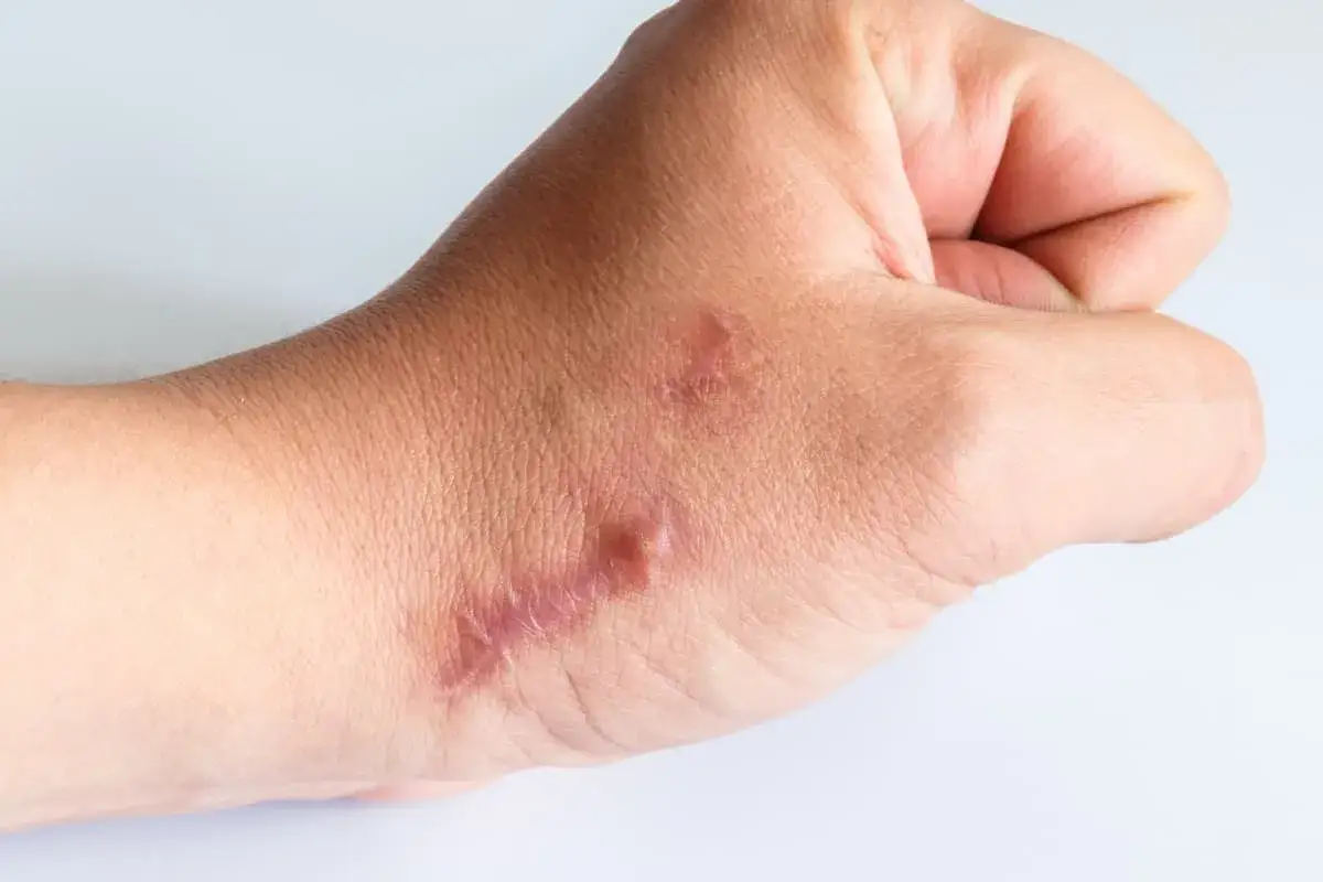 Mano con cheloidi, cicatrici in rilievo che mostrano cos'&egrave; un cheloide.