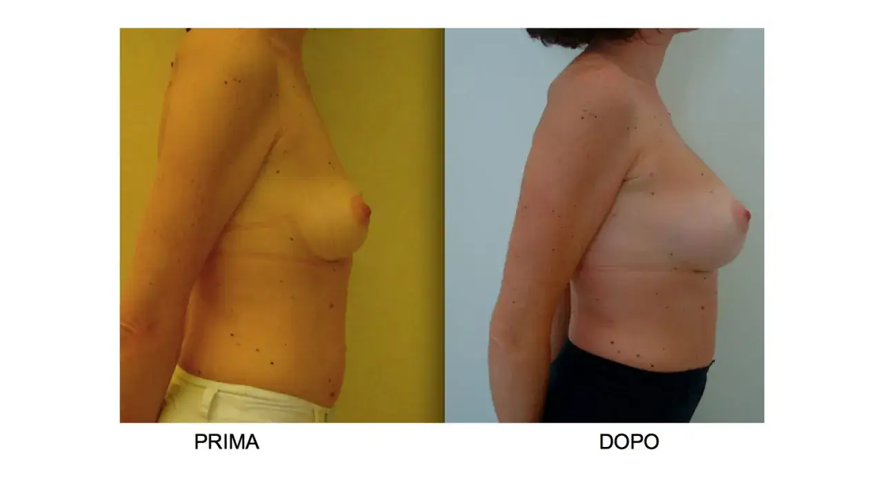 Confronto seno rifatto prima e dopo: immagine mostra il profilo di una donna prima e dopo un intervento di mastoplastica additiva, evidenziando il cambiamento.