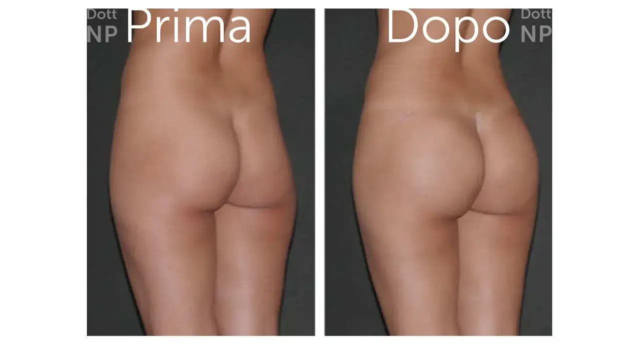 Prima e dopo: come riconoscere un sedere rifatto. Confronto visivo di un intervento estetico.