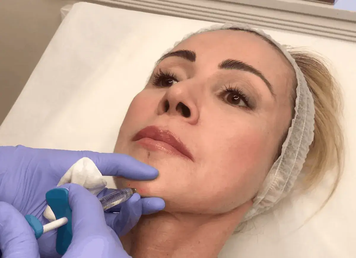 Dettaglio del viso di una donna durante un trattamento di filler per il contouring. Mani con guanti blu iniettano il prodotto.
