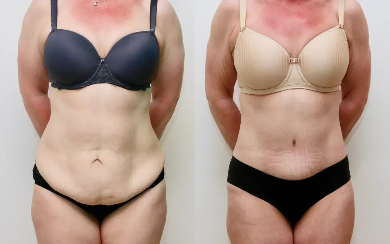 Side-by-side comparison of a woman's abdomen before and after abdominoplasty.