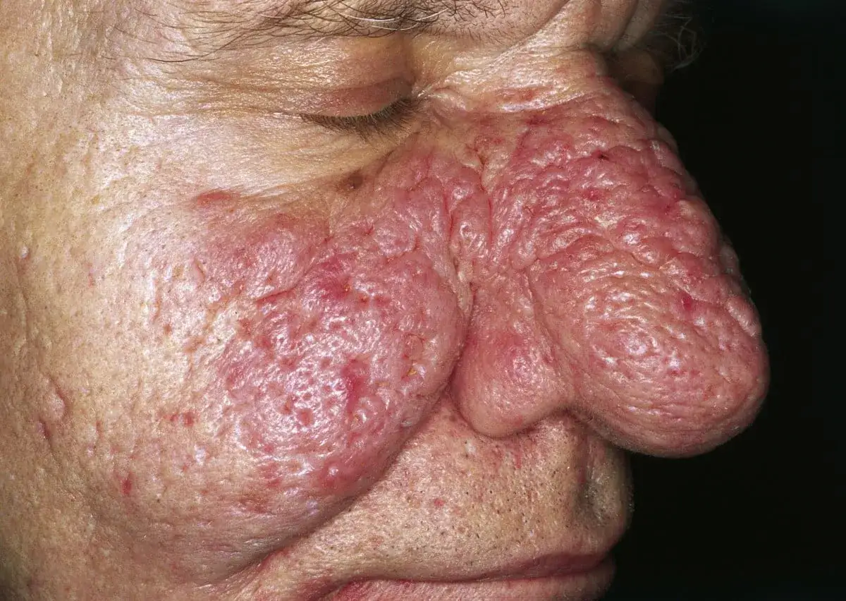 Primo piano del naso e della guancia di un uomo con rinofima. La pelle &egrave; arrossata, ispessita e presenta noduli. Potrebbe essere utile una crema per rinofima.