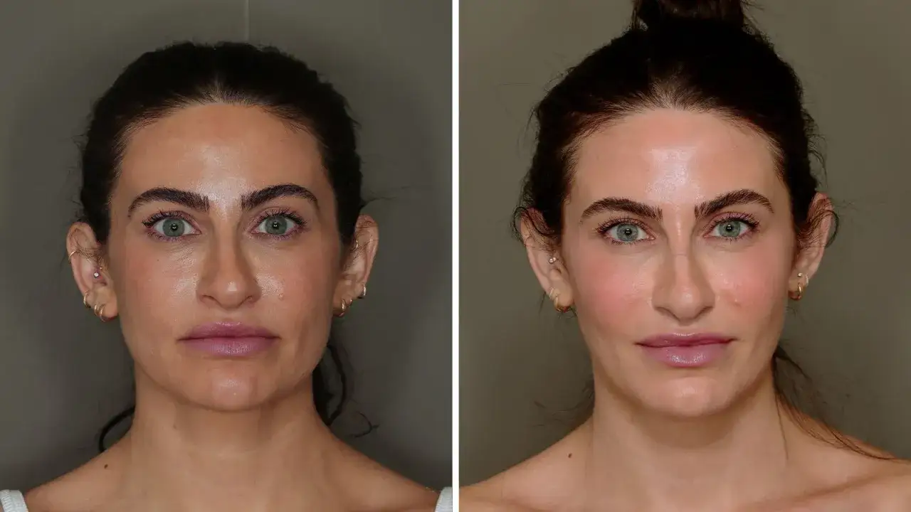 Confronto prima/dopo: il lipofilling viso ha creato un aspetto innaturale, con guance troppo piene e labbra gonfie. Esperienze negative da considerare.