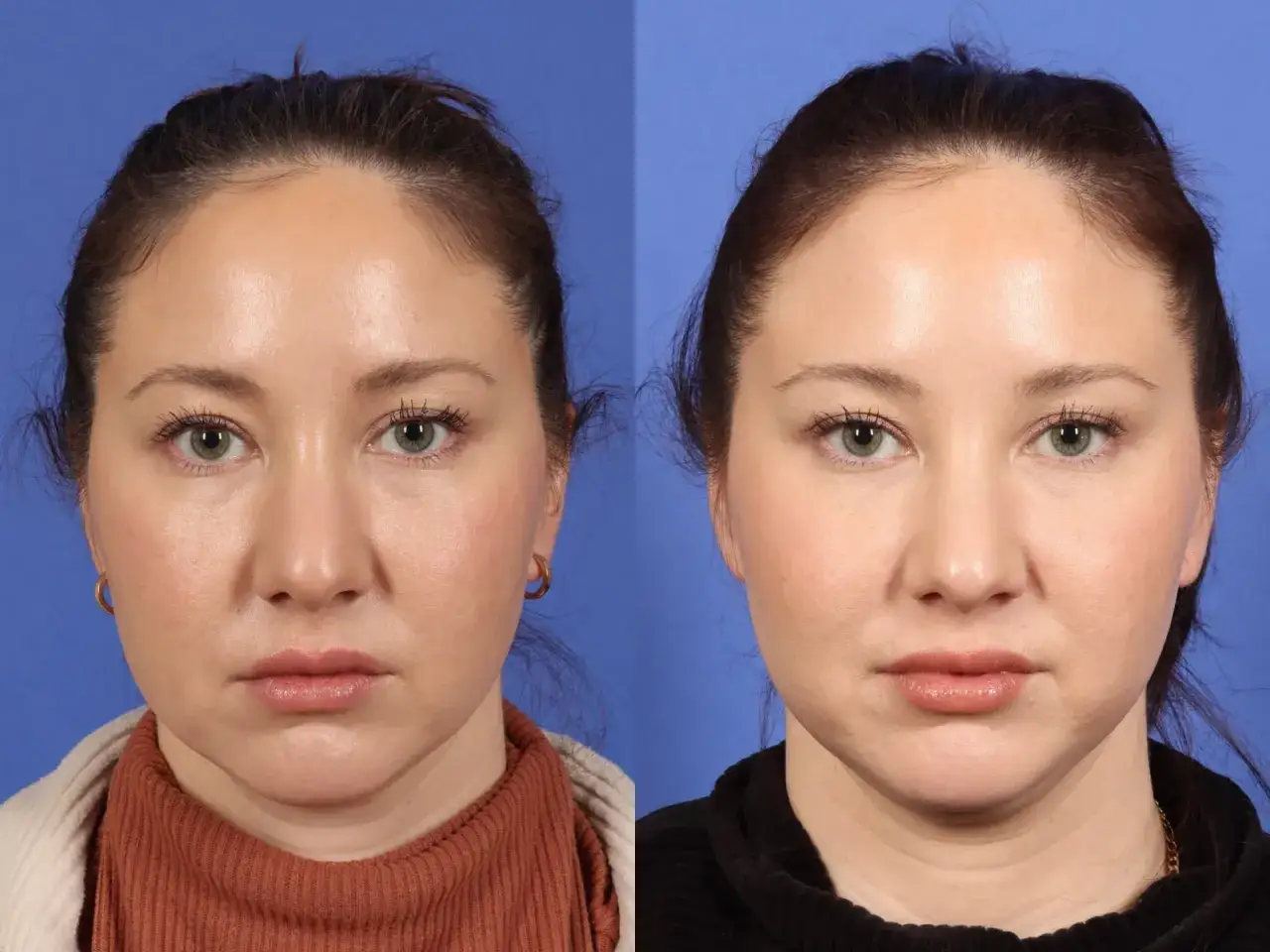 Confronto prima/dopo di un trattamento estetico. La pelle appare più liscia e distesa, suggerendo un effetto duraturo. Quanto dura il botox?