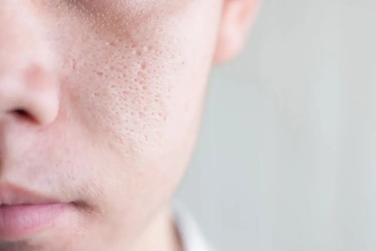 Primo piano del viso con pori dilatati visibili, che suggeriscono la necessità di un peeling per migliorare la texture della pelle.