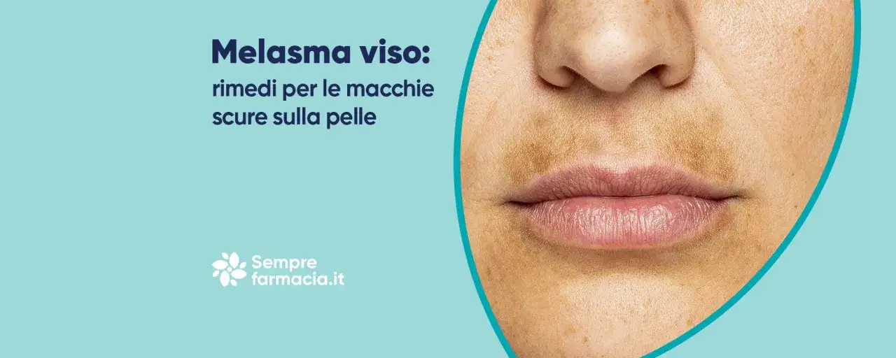 Primo piano del viso con zona baffetti scura e macchie cutanee. Melasma viso: rimedi per le macchie scure sulla pelle.