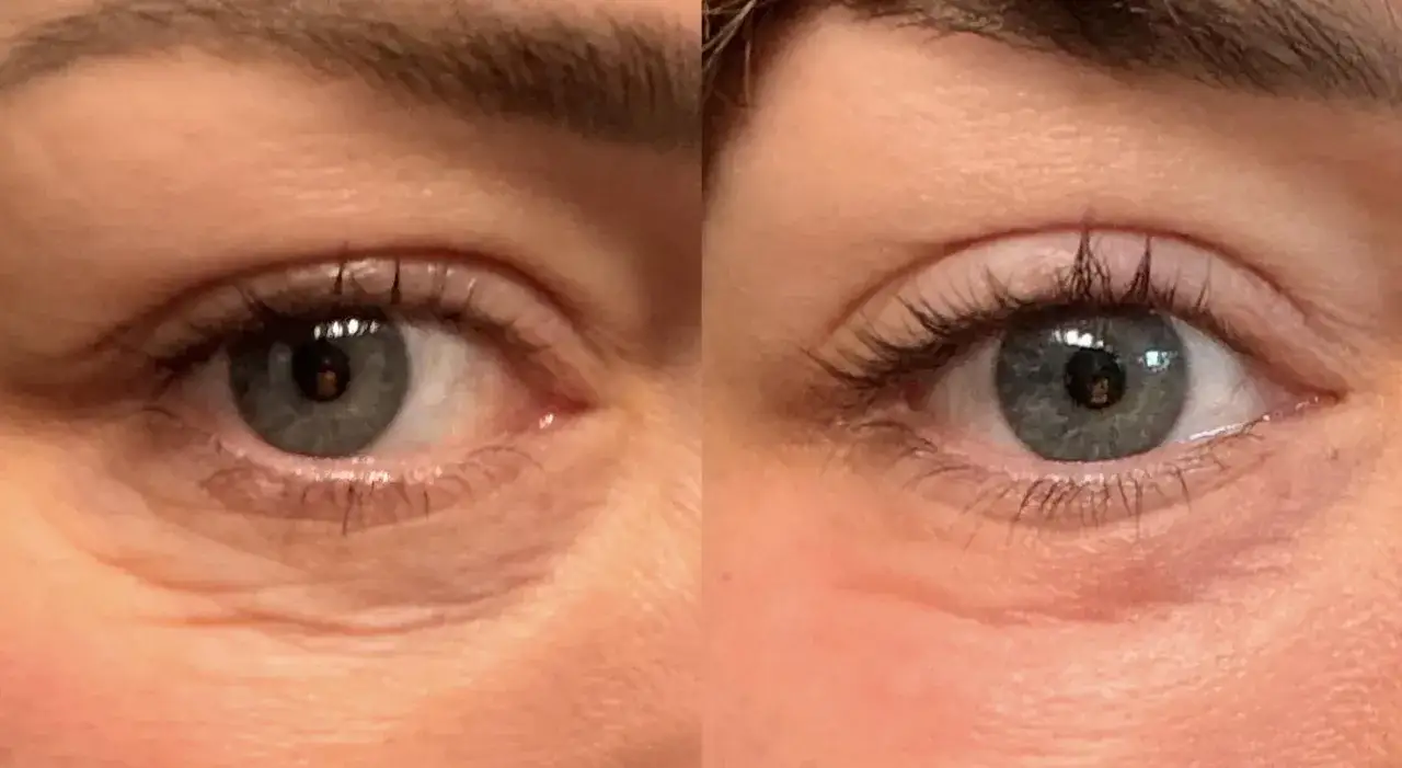 Occhi prima e dopo peeling TCA: rughe attenuate e pelle più liscia.