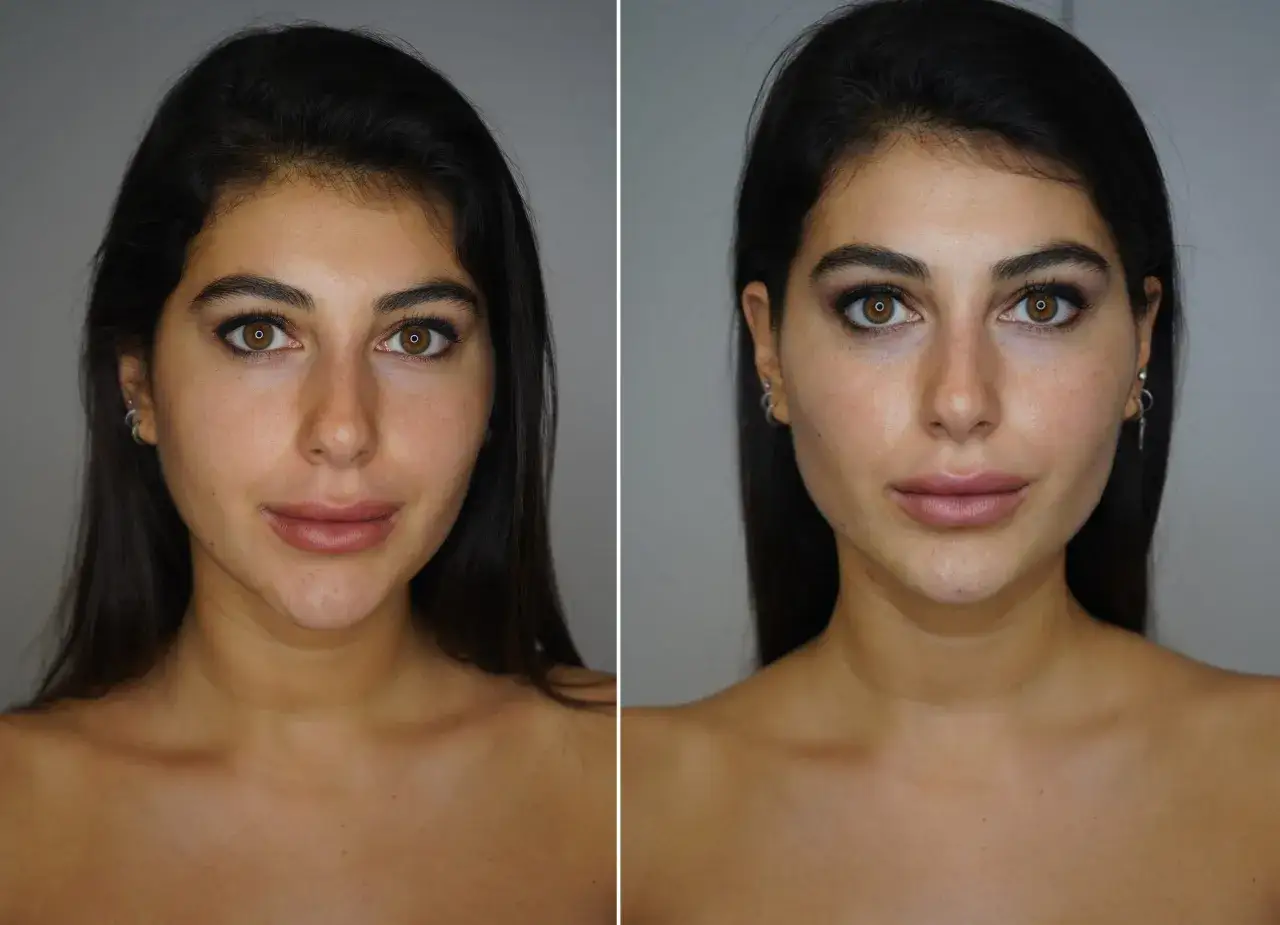 Prima e dopo: il filler mascella donna definisce il contorno del viso, rendendolo più armonioso e proporzionato.