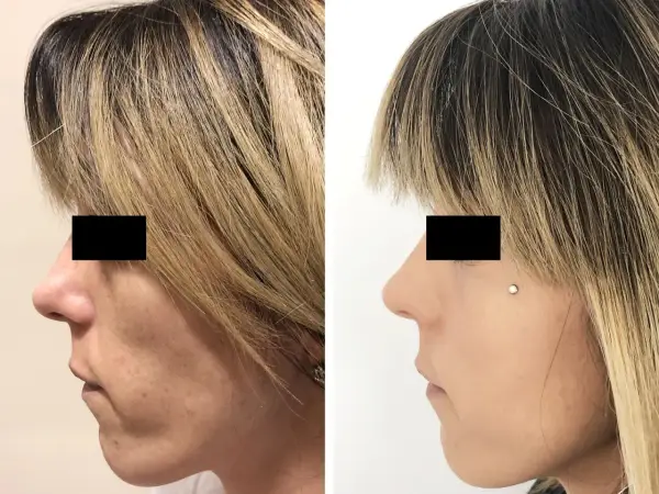 Prima e dopo lipofilling viso: il lato sinistro mostra un viso con contorni meno definiti, il destro un viso più armonioso. Esperienze negative da valutare.