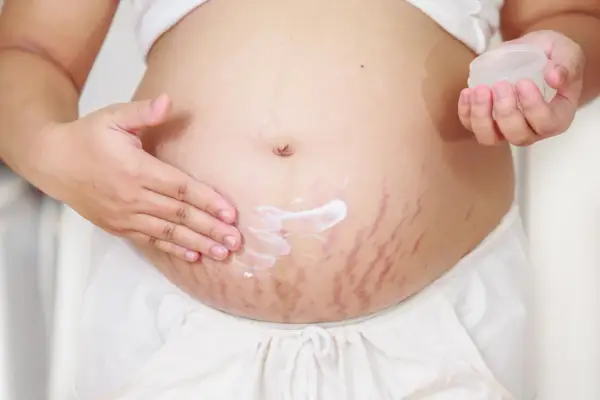 Pancia con smagliature rosse, una mano applica crema idratante per capire perchè vengono le smagliature.