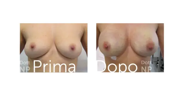 Prima e dopo: un confronto visivo che mostra un aumento del volume del seno, trasformando tette piccole in forme più piene e definite.