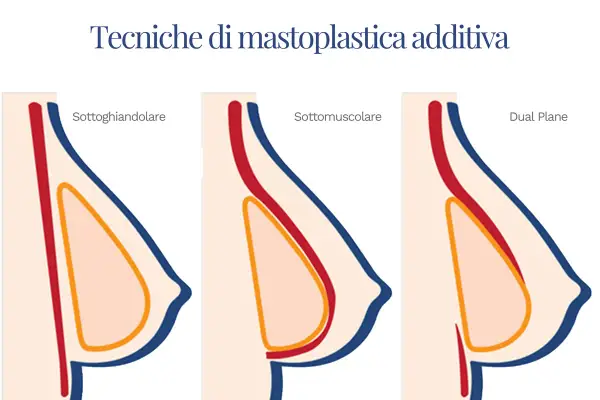 Illustrazione delle tecniche di mastoplastica additiva: sottoghiandolare, sottomuscolare e Dual Plane. Le opinioni sulla tecnica Dual Plane variano.
