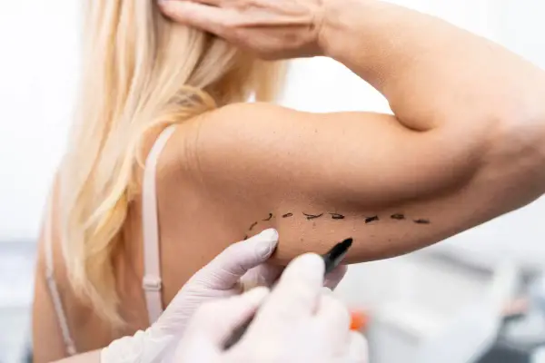 Medico disegna con pennarello su braccio, segnando una nuova tecnica per lifting braccia.