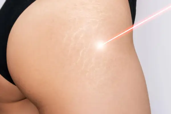 Laser treatment on skin with smagliature, showing a path to come eliminare le smagliature.