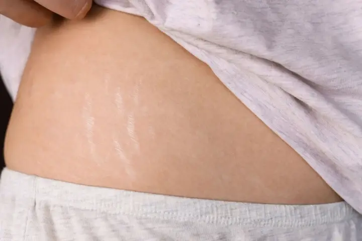 Pelle con smagliature sul fianco, segno di cambiamenti corporei.