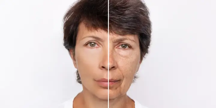 Confronto visivo: metà volto giovane e liscia, metà volto segnato dal tempo e dalle macchie solari, effetto ringiovanente con Morpheus 8.