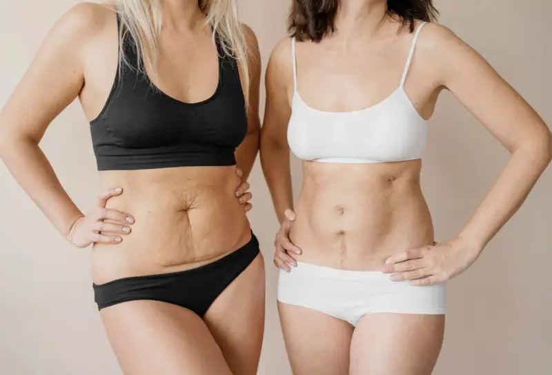 Due donne mostrano i loro addomi, uno con smagliature e l'altro con una cicatrice, un confronto prima e dopo un mommy makeover.