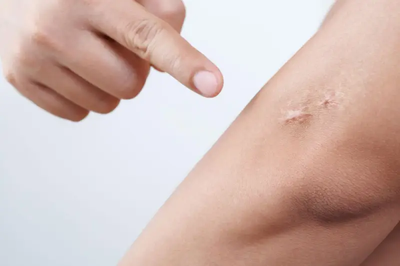 Dito si vede un dito che indica una cicatrice rialzata sulla pelle. Questa è una cheloide, una crescita anomala di tessuto cicatriziale.