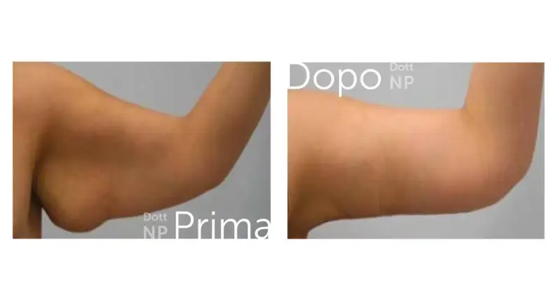 Prima e dopo liposuzione braccia: un braccio più tonico e definito.