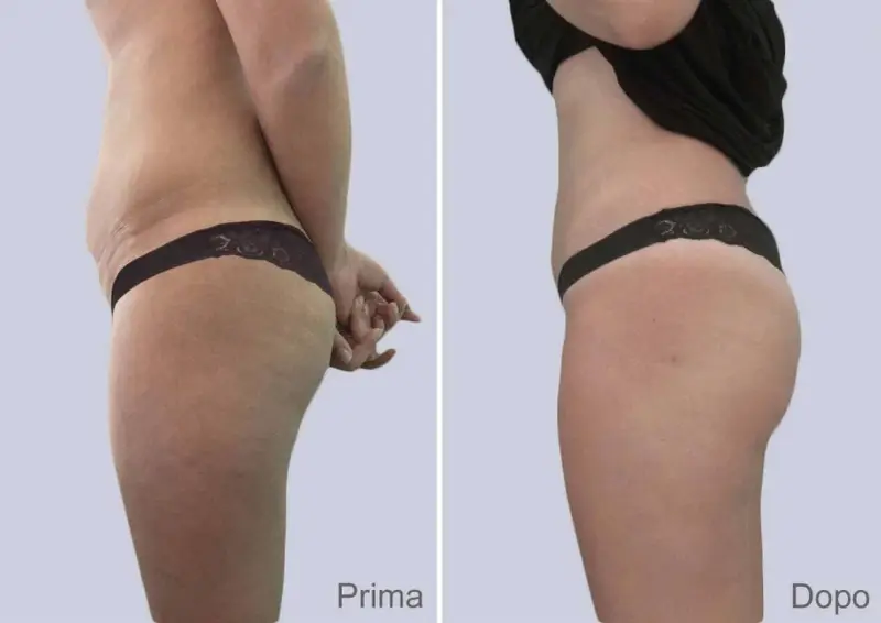 Confronto prima e dopo: la liposuzione come funziona per rimodellare il corpo, riducendo accumuli adiposi e migliorando la silhouette.